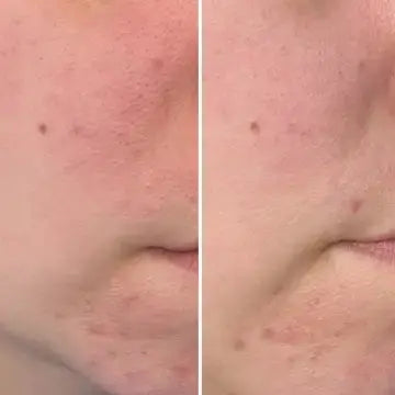 Take Control Salicylic + 10% Azelaic Serum